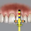 Recharge pour jauge allongement de couronne T-BAR (3 pièces)