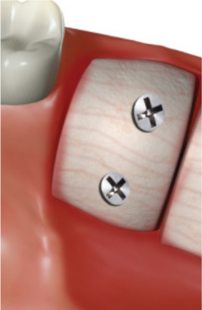 Mini vis auto-taraudeuse Dia. 2.0 * 12mm - Jeil Medical Mini vis auto-taraudeuse Dia. 2.0 * 12mm - Jeil Medical Mini vis auto-taraudeuse Dia. 2.0 * 14mm - Jeil Medical