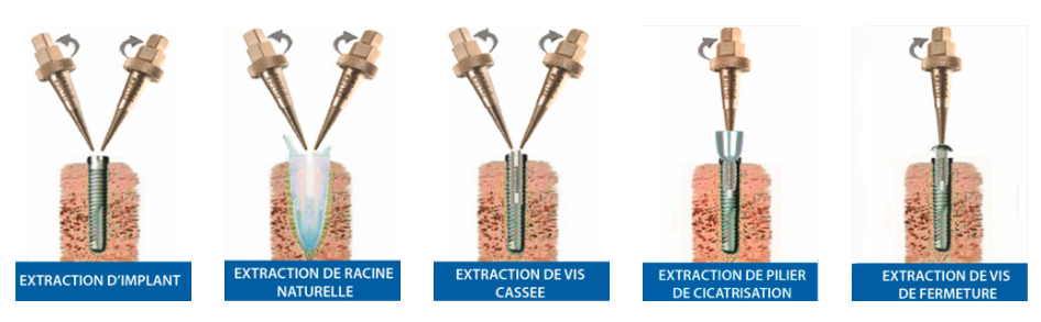 Extracteur d’implants - OXYLABO