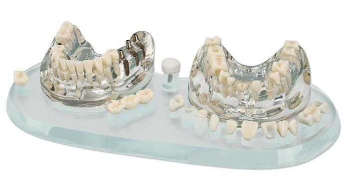 Implant C+B pour étude de modèle démonstration - Hager&Werken - Delynov