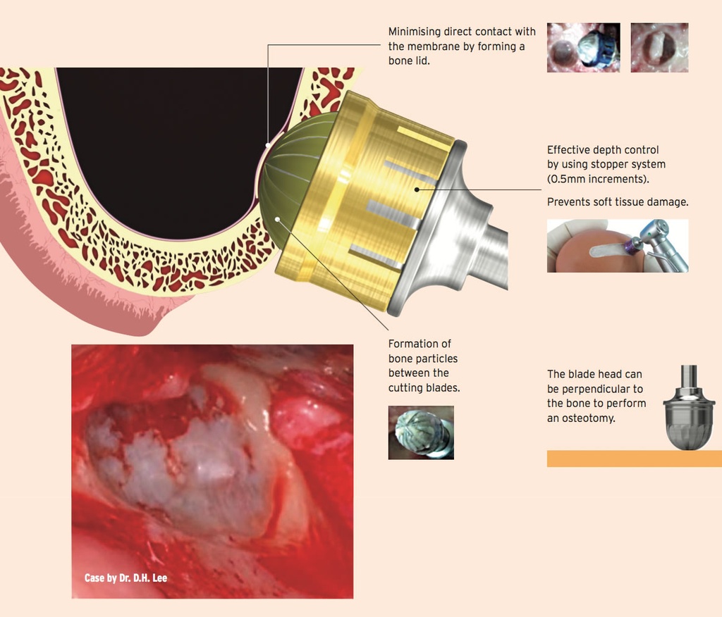 Kit d'approche latérale du sinus (KALS) (HLRSNK) OSSTEM - DELYNOV