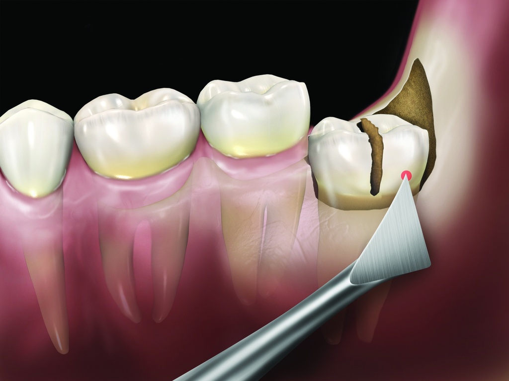 Elévateur Mini Cryer droit - Hu-Friedy - Delynov