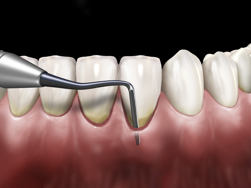 Couteau à gencive Allen #1/2 manche #6 - Hu-Friedy - Delynov