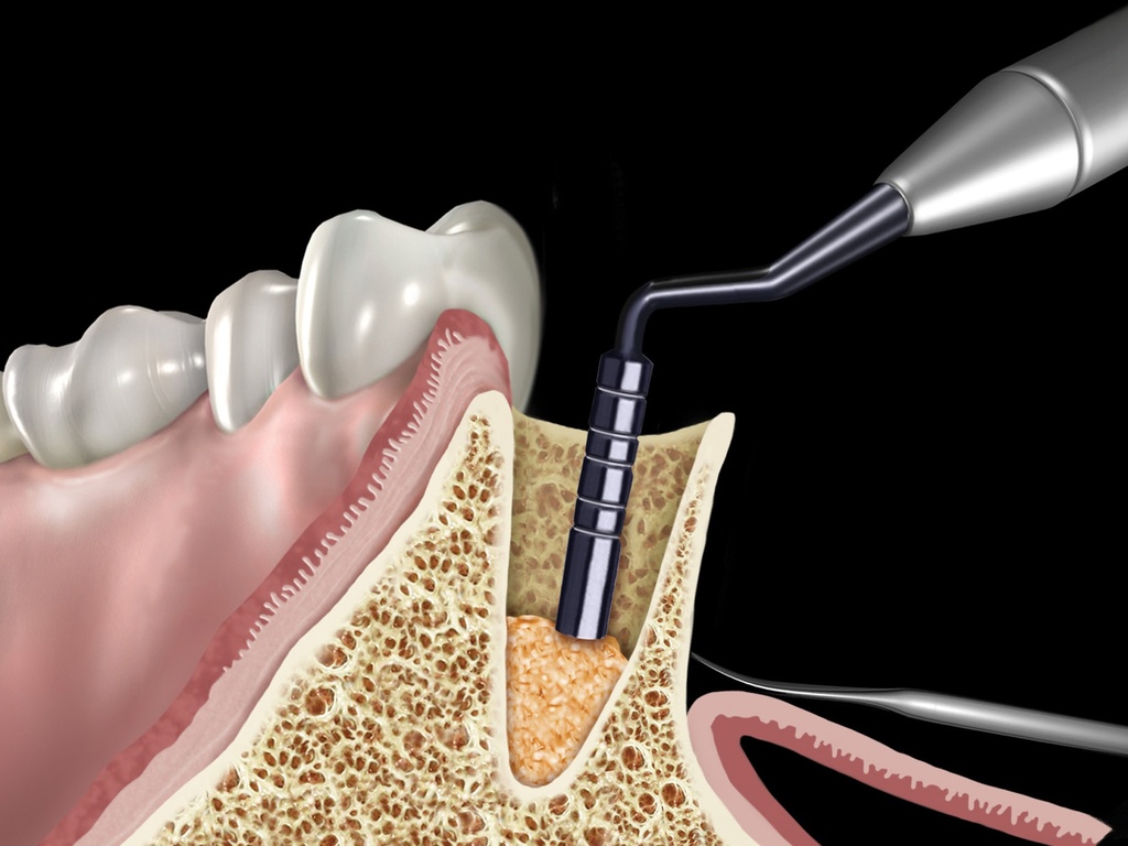 Scissors Zerfing Handle number 6 - Hu-Friedy - Delynov