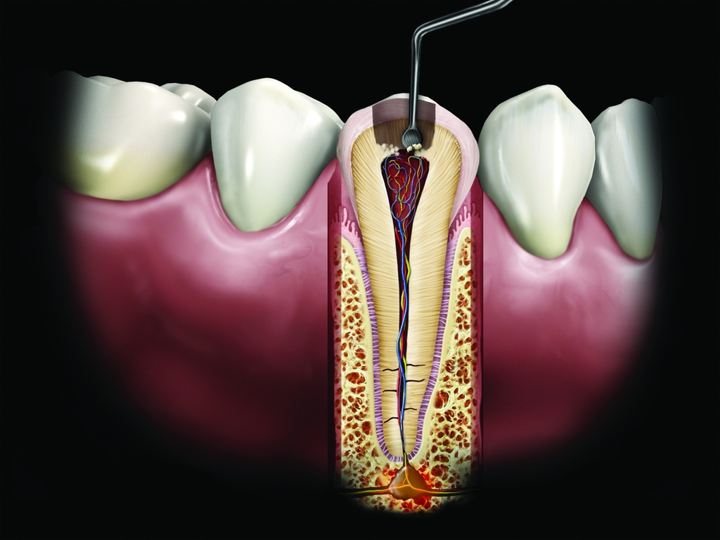 Excavateur #33L manche #41 pulpaire - Hu-Friedy - Delynov