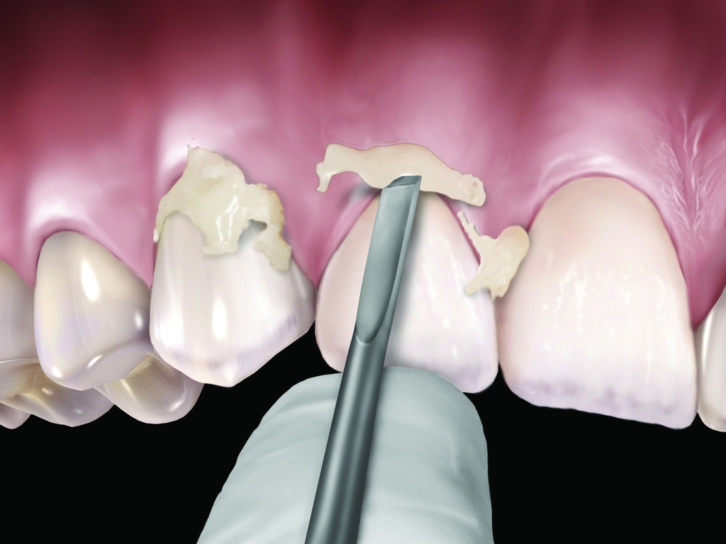 Enlève ciment Novatech #12 manche #2 - Hu-Friedy - Delynov