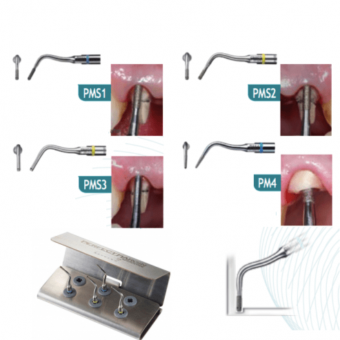 Kit d'inserts pour la chirurgie parodontale (F00936) - Delynov