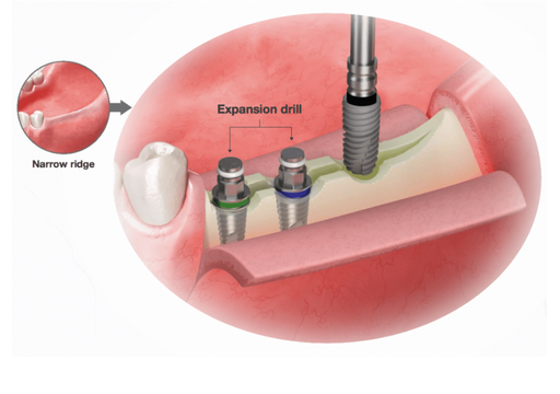 Kit de division et d'expansion facile sur une crête étroite Osstem - Delynov pour l'implantologie, la chirurgie orale, la chirurgie dentaire, le chirurgien-dentiste, la greffe osseuse et la chirurgie maxillo-faciale.