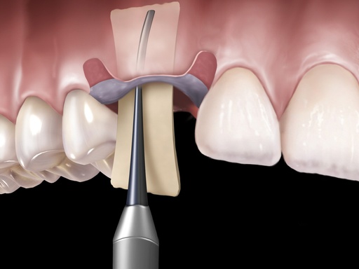 [PMPI] Positioner Membrane Handle Number 2 - Hu-Friedy - Delynov